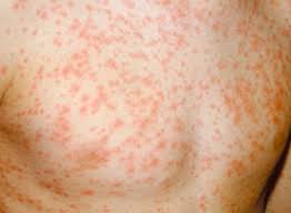 Selain itu, jangkitan itu boleh merebak melalui sentuhan atau pernafasan apabila partikel virus yang terdapat pada cecair yang keluar daripada lepuh (blister) terkena orang lain. Makanan Penyebab Rubella Hindari Anak Pada Jenis Makanan Ini Jika Tidak Ingin Tertular Virusnya Semua Halaman Sajian Sedap