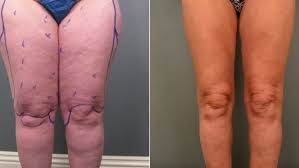 Pin On Lipedema