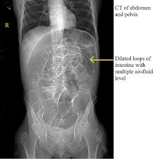 Image result for Adynamic Ileus