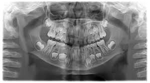 Panoramic Dental X-Ray Of Child - 7 Years, All Teeth In View Stock Photo,  Picture and Royalty Free Image. Image 33484077.