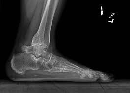 Chronic Ankle Pain Put Os Trigonum Fracture In The Differential Lower Extremity Review Magazine