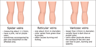 5 Stages Of Vein Disease That You Need To Know Vein Disease