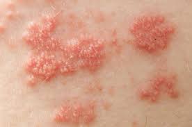 Image result for heat rash under breasts