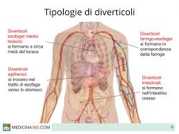 Il mondo delle erbe ci offre valenti alleati in caso di diverticolite. Diverticoli Intestinali Esofagei Ed Al Colon Sintomi Dieta E Cura