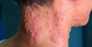 Herpes zóster, una enfermedad viral dolorosa pero controlable | Universidad Privada Franz Tamayo