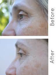 Our exclusive formula accelerates the removal of old, dull skin cells on the surface revealing fresh, new ones. Roc Retinol Skin Care Review With Before And After Photos