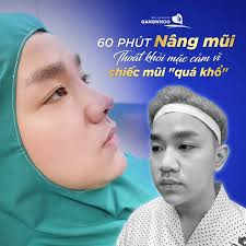 Nâng Mũi Dáng Trung Hoa