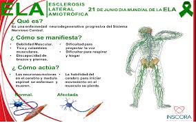 Los síntomas iniciales varían con cada persona, pero por lo general incluyen tropezarse, dejar. Ela 21 De Junnio Dia Mundial De La Esclerosis Lateral Amiotrofica Esclerosis Lateral Esclerosis Lateral Amiotrofica Esclerosis