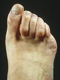 10 Common Foot Problems Foot Health Center Everyday Health Foot Problem Brown Toenail Foot Health