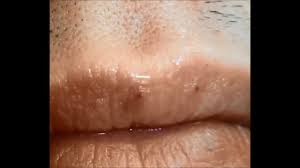 Cherry angiomas are made up of clusters of capillaries at the surface of the skin, forming a tiny round dome ( papule), which might be flat topped. Lip Angiomas Treated With Advatx Youtube
