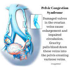 Pelvic Congestion Syndrome Pelvic Congestion Syndrome Endometriosis Awareness Interventional Radiology