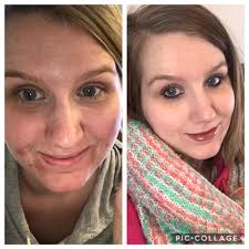 My skin was so clear before pregnancy like wtf 😞