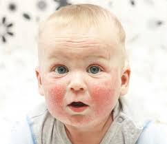 Image result for Atopic Dermatitis