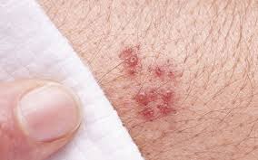 Gurtelrose Herpes Zoster Erste Anzeichen Typische Symptome Behandlung Dauer Onmeda De