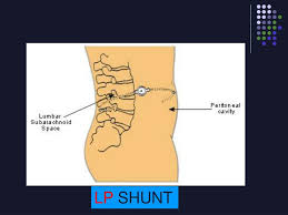 Ppt Vp Shunts Powerpoint Presentation Free Download Id 3387790