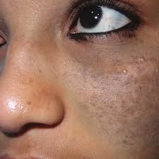 Image result for nevus sclerae