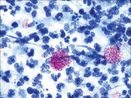 A scurfy, mealy substance on the surface of some plants. Lepra Cells Large Cells With Their Pathology Discussion Forum Facebook