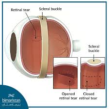 Image result for Retinal Detachment