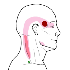 Headache At Your Temple With Stiff Neck Integrative Works Headache Trigger Points Chronic Migraines