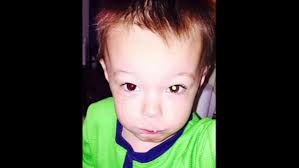 Avery Fitzgerald: Eye cancer diagnosed after cell phone photo