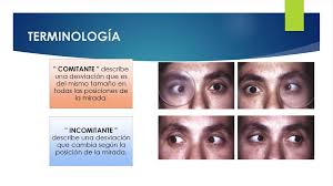 ESTRABISMO Medicina Humana