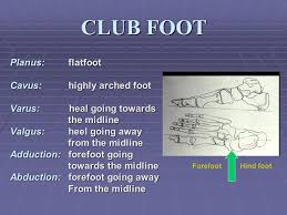 The condition is also known as talipes or talipes equinovarus. Congenital Talipes Equino Varus Congenital Clubfoot Ppt Video Online Download