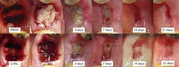 Tooth extraction is more common than you might think. References In Efficacy Of Plasma Rich Growth Factor In The Healing Of Postextraction Sockets In Patients Affected By Insulin Dependent Diabetes Mellitus Journal Of Oral And Maxillofacial Surgery