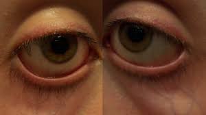 Problems that don't allow your eyelids to close the way they should. Sunken Eyes Causes Pictures And Treatments