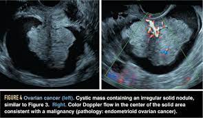 These benign tumors actually grow about one to two millimeters per year. Gynecologic Ultrasound Primer How Not To Miss The Diagnosis