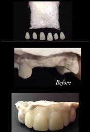 We recommend that you undertake this procedure from a qualified dentist and selecting a durable material. Missing Tooth Kit Select Your Teeth Front Flipper Denture Etsy Veneers Teeth Tooth Replacement Dental Veneers