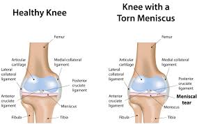 What to expect after arthroscopic knee surgery symptomfind arthroscopic knee surgery knee replacement exercises knee surgery from www.pinterest.com. Meniscal Repair Surgery Cost And Procedure Guide