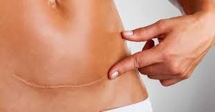 Nanti sayang nak lahirkan anak abang seramai 5 orang. Bolehkah Bersalin Normal Sebaik Selepas Bersalin Secara Pembedahan Caesarean