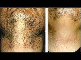 The following procedure is performed by a board certified medical electrologist; Laser Hair Removal Miami Help W Black Men S Beards Youtube