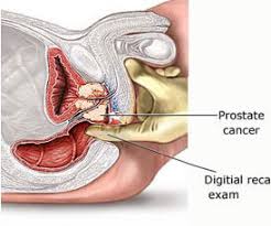 Image result for Radical Prostatectomy