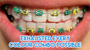 In addition to being negatively affected by braces health, many people need braces because it causes physical. 15 Must Knows About Braces For Potential Metalmouths To Survive The Next Two Years