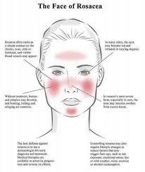 April Is Rosacea Awareness Month According To The National Rosacea Society Over 16 Million People Suffer From Rosacea Rosacea Acne Rosacea Rosacea Skin Care