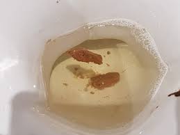 Some foods are much harder to digest than others and therefore may however, when undigested food regularly occurs in your stool and is accompanied by other ibs symptoms such as abdominal pain, constipation, mucus. Possible Parasites In Stool Irritable Bowel Syndrome Forums Patient