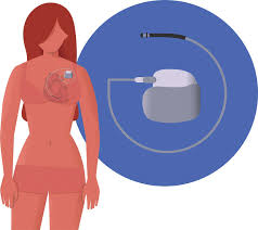 Keep headphones at least six inches away from your icd or pacemaker. The Implantable Cardioverter Defibrillator Icd Delivers Shocks When Download Scientific Diagram