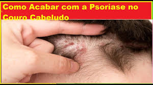 Na psoríase do couro cabeludo, essas manchas afetam a pele da cabeça. Como Tratar Psoriase Na Cabeca Do Couro Cabeludo Youtube