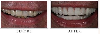 Dental Implants Smile La Com