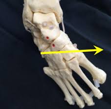 Here are all the possible meanings and translations of the word club foot. Introduction To Clubfoot Physiopedia