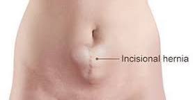 نظف الغرفة الجسم مزراب اعراض فتح العمليه القيصريه من الداخل comertinsaat com