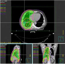This cancer develops in the layer of tissue that covers many internal organs in the body. The Use Of Radiation Therapy For The Treatment Of Malignant Pleural Mesothelioma Expert Opinion From The National Cancer Institute Thoracic Malignancy Steering Committee International Association For The Study Of Lung Cancer And