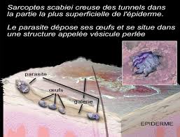 Les enfants atteints de gale doivent rester à la maison plusieurs jours pour éviter de transmettre la maladie. Dermato Info La Gale