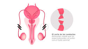 Después de una vasectomía, los espermatozoides no pueden salir de los testículos.un hombre que se haya realizado una vasectomía exitosa no puede embarazar a una mujer. Vasectomia Un Efectivo Metodo Para Controlar La Natalidad