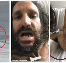 Shark bites 7-year-old in Fort Lauderdale; Aussie spearfisherman's leg  bitten