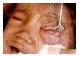 Featured story gamal newry trainer preventative measures i've been a member of asis now for about 15 years. Orbital Myiasis Due To Invasion Of Larvae Of Flesh Fly Wohlfahrtia Magnifica In A Child Rare Presentation