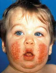 8 viral exanthems of childhood