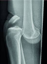 Image result for Knee Dislocation