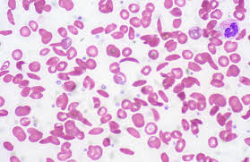Anemia mediterránea — anemia hemolítica caracterizada por hematíes microcíticos, hipocrómicos y de vida corta, causada por una síntesis deficiente de hemoglobina deficiente. Il Ruolo Del Ferro Nel Trattamento Dell Anemia Mediterranea Cure Naturali It